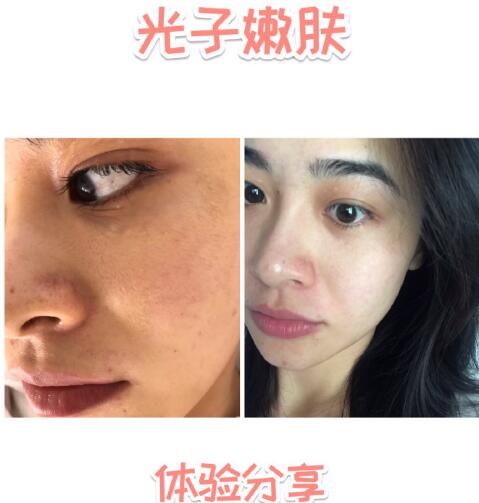 福州愛思特比華利整形林秋蓉醫(yī)生做光子嫩膚過程體驗(yàn) 福州愛思特比華利整形林秋蓉醫(yī)生做光子嫩膚過程體驗(yàn)