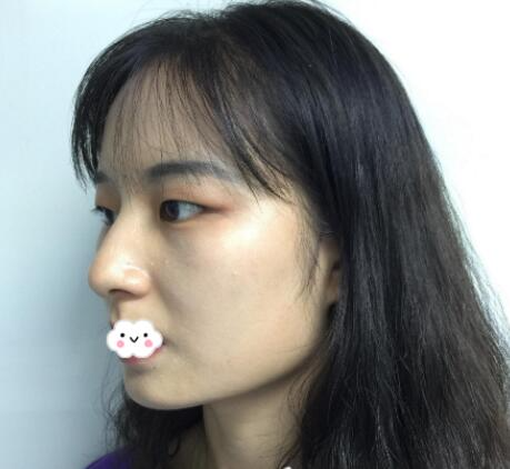 北京玲瓏梵宮整形醫(yī)生張蔚宣下頜角案例100天效果對(duì)比圖