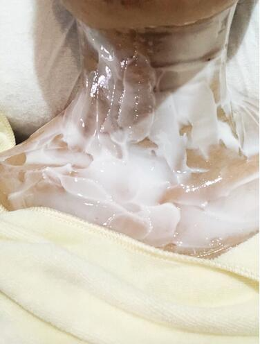  安徽韓美整形醫(yī)院吳美珍醫(yī)生液態(tài)超聲刀去頸紋案例，讓你的皮膚回到18歲