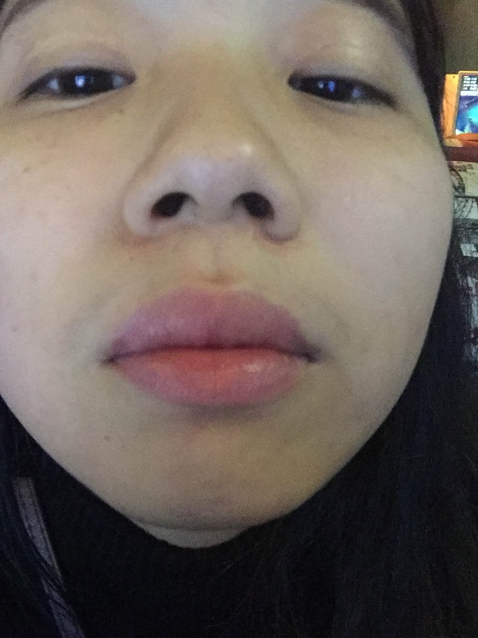 滄州瑞美醫(yī)療美容門(mén)診部整形醫(yī)生王波鼻骨縮窄案例