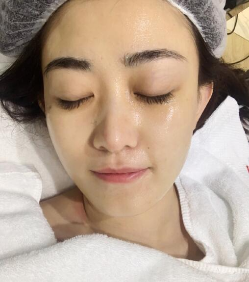 贛州韓美整形吳彩霞果酸換膚效果對(duì)比圖