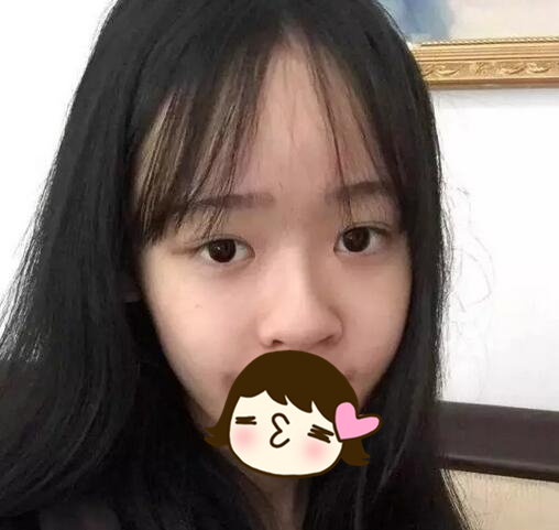 廈門(mén)海峽整形美容醫(yī)院隆鼻手術(shù)案例效果