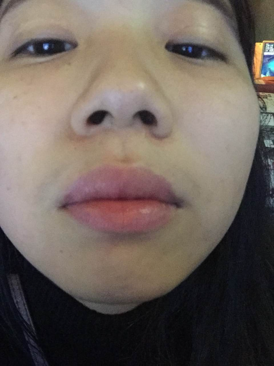 滄州瑞美醫(yī)療美容門診部王波醫(yī)生鼻骨縮窄案例，拯救了我的丑鼻子