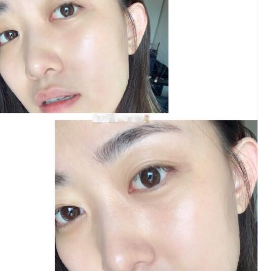 果酸換膚后 果酸換膚后