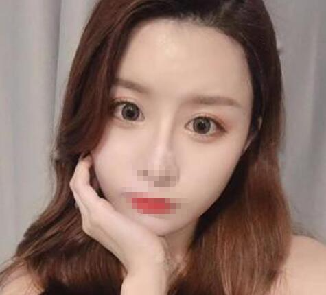 鄭州風(fēng)信子整形美容醫(yī)院雙眼皮案例效果對比圖分享