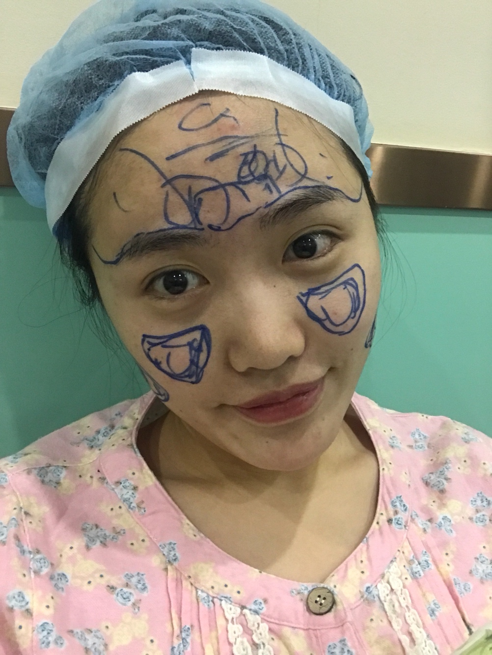 北京星美李寧輝進口膨體隆鼻案例 北京星美李寧輝進口膨體隆鼻案例