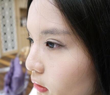 做完雙眼皮手術(shù)恢復(fù)后的效果