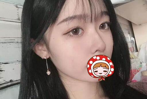 廈門(mén)海峽整形美容醫(yī)院隆鼻手術(shù)案例最終效果