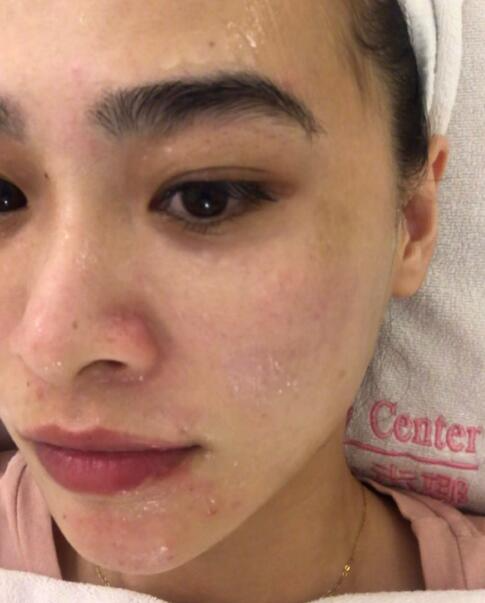 福州愛思特比華利整形林秋蓉醫(yī)生做光子嫩膚過程體驗！皮膚Q彈