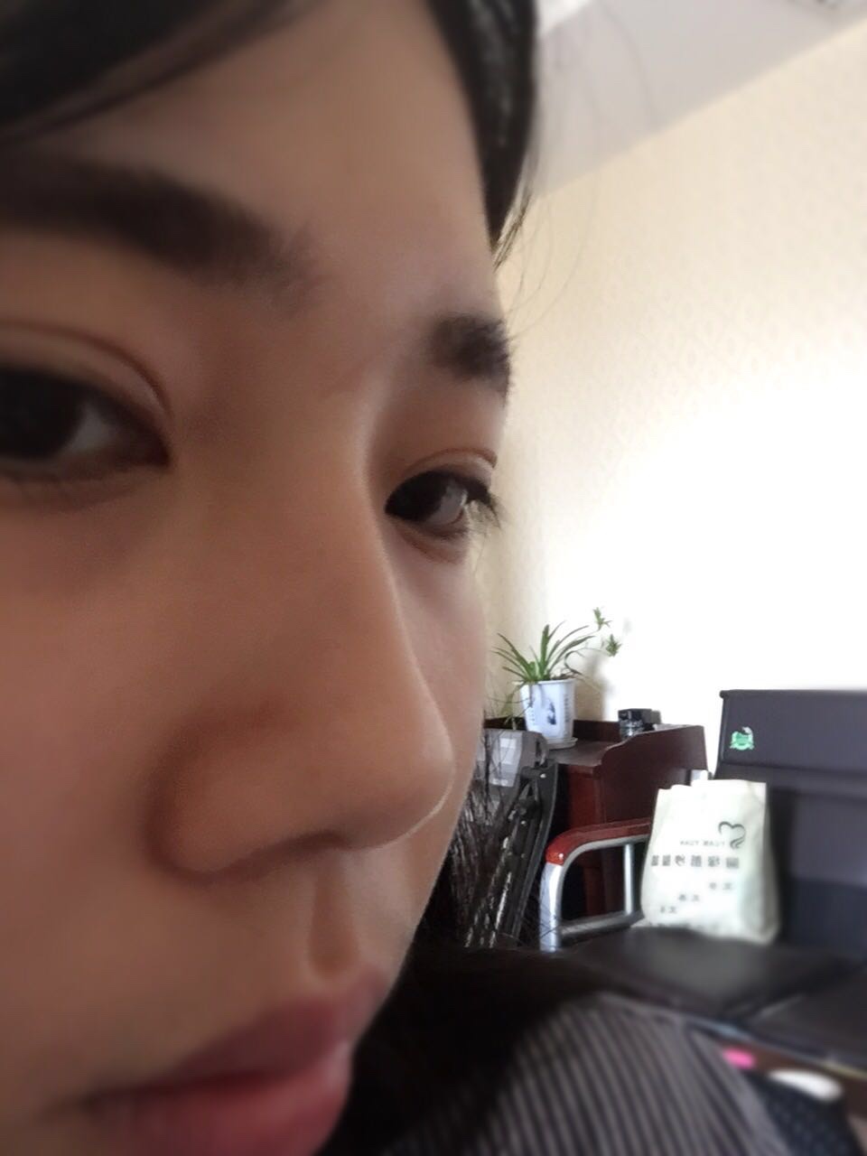 做完鼻骨縮窄手術(shù)一個(gè)多月的樣子