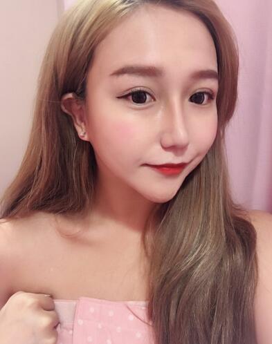 上海藝星醫(yī)療美容醫(yī)院整形醫(yī)生宗建華激光脫毛案例