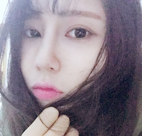 滄州瑞美醫(yī)療美容門診部王波醫(yī)生鼻骨縮窄案例，拯救了我的丑鼻子