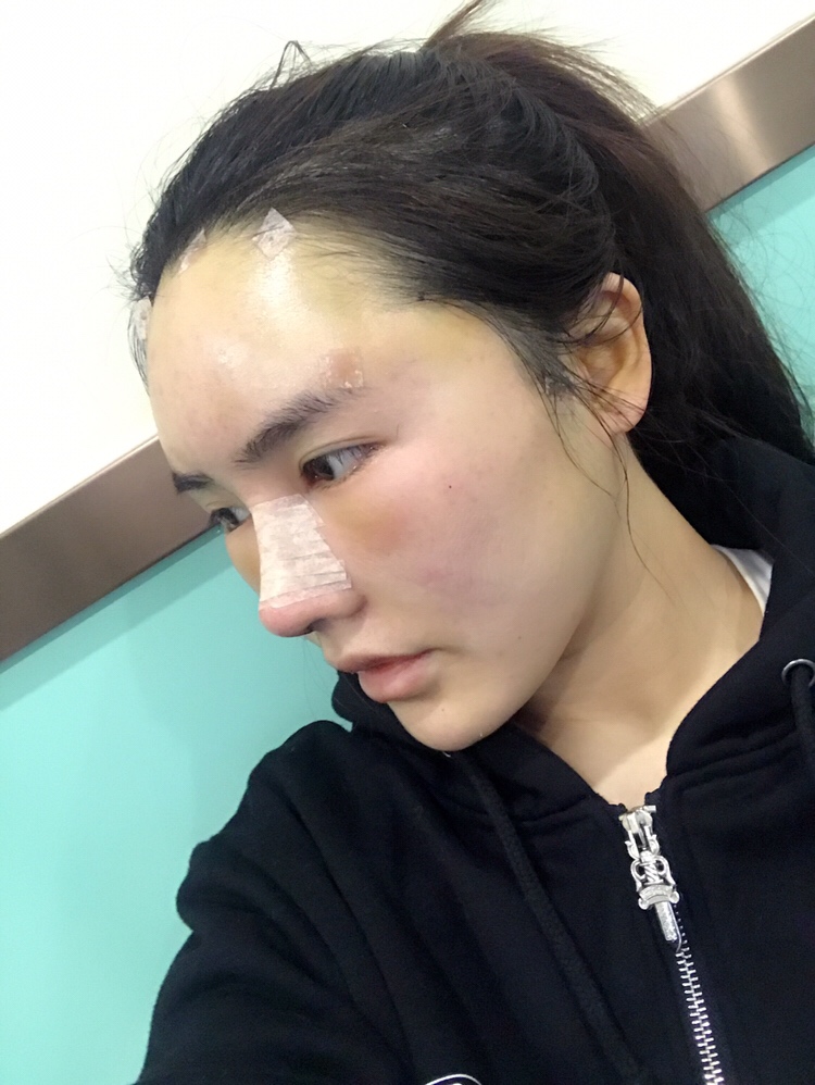 膨體隆鼻手術過程 膨體隆鼻手術過程