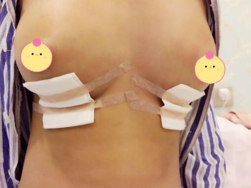 琴面假體隆胸手術(shù)剛結(jié)束的時(shí)候 琴面假體隆胸手術(shù)剛結(jié)束的時(shí)候