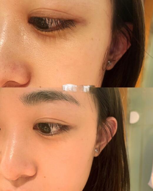 果酸換膚中 果酸換膚中