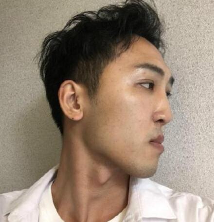 下頜角磨骨手術(shù)之前 下頜角磨骨手術(shù)之前