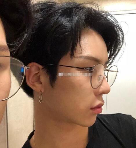 徐學東男士下頜角手術(shù)后的療效