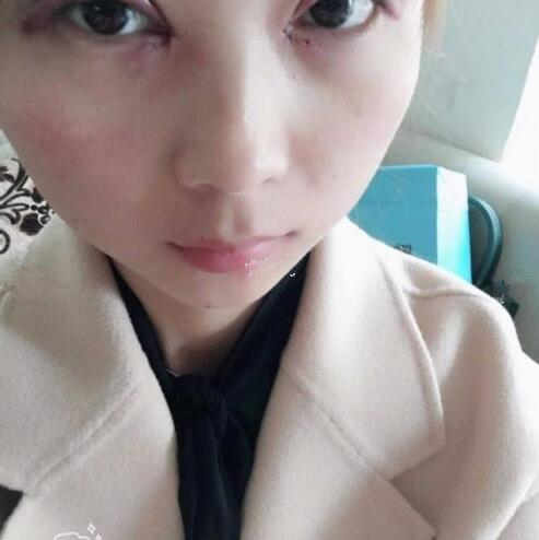 淄博美聯(lián)臣醫(yī)療美容醫(yī)院做切開雙眼皮怎么樣?切開雙眼皮案例分享