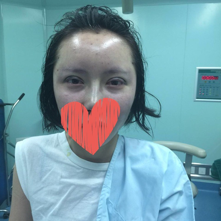 杜園園開外眼角案例效果對比圖 杜園園開外眼角案例效果對比圖