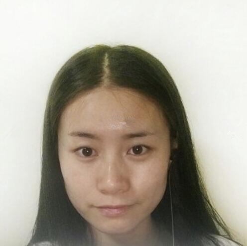 長(zhǎng)春銘妍醫(yī)療美容門(mén)診部雙眼皮整形案例。