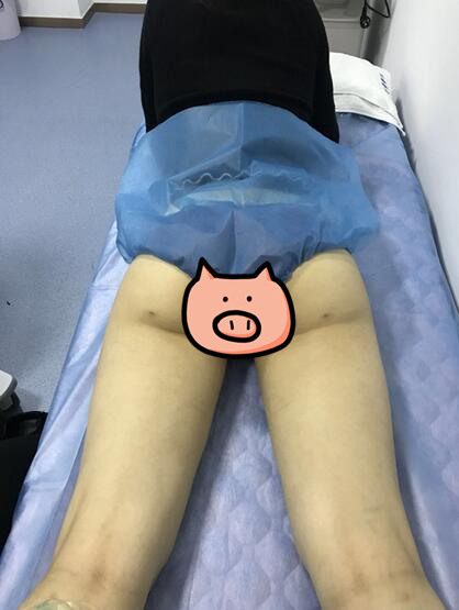 劉永生做大腿吸脂案例
