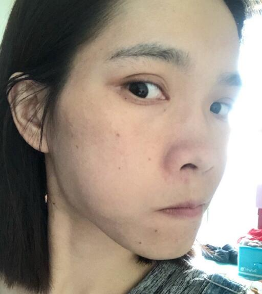 北京藝星整形專家廖苑利做光子嫩膚怎么樣？廖苑利光子嫩膚案例效果展示