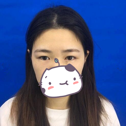 西昌玥美整形專家湯穎峰做雙眼皮怎么樣?湯穎峰雙眼皮案例賞析