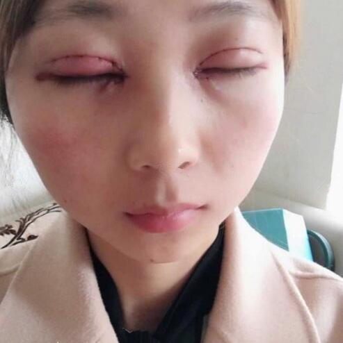 切開雙眼皮案例分享
