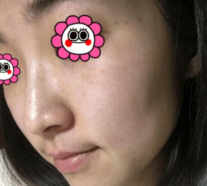 剛做完彩光嫩膚的效果 剛做完彩光嫩膚的效果