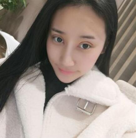 北京葉子整形美容醫(yī)院做焊接雙眼皮效果怎么樣？北京葉子整形焊接雙眼皮案例展示