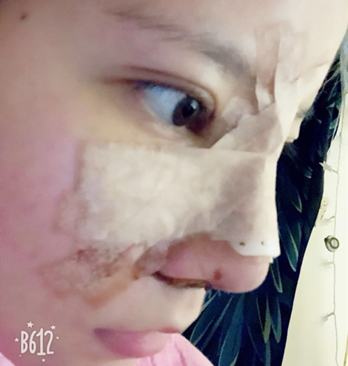 嘉興曙光美容醫(yī)院整形專家王良發(fā)做假體隆鼻怎么樣？王良發(fā)假體隆鼻案例