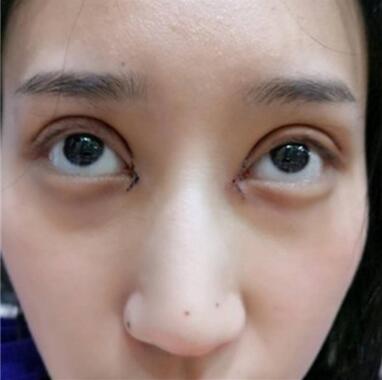 北京葉子整形焊接雙眼皮案例展示 北京葉子整形焊接雙眼皮案例展示