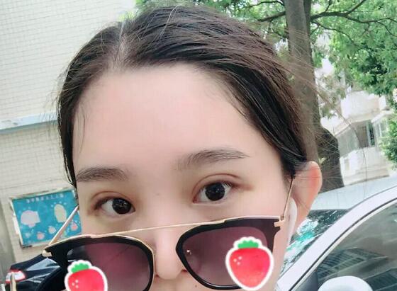 鄭州蕾娜斯彭沖醫(yī)生做微創(chuàng)雙眼皮案例效果對比圖