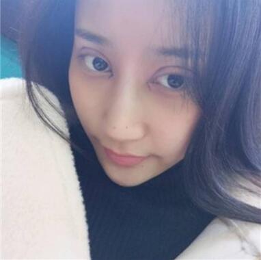 北京葉子整形焊接雙眼皮案例展示 北京葉子整形焊接雙眼皮案例展示