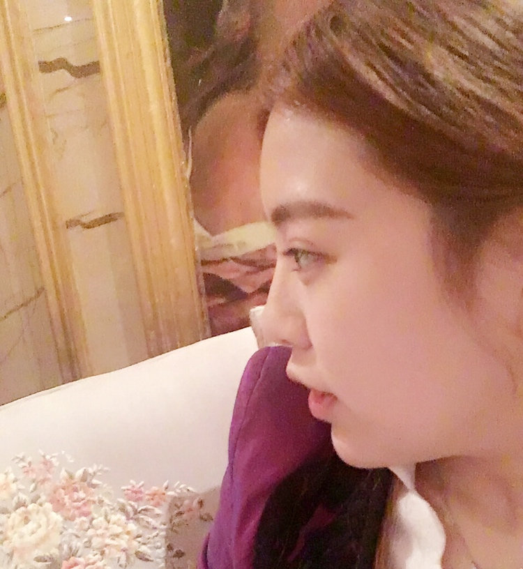 黑龍江藝星醫(yī)生巫文云做鼻部修復(fù)怎么樣，巫文云玻鼻部修復(fù)案例分享