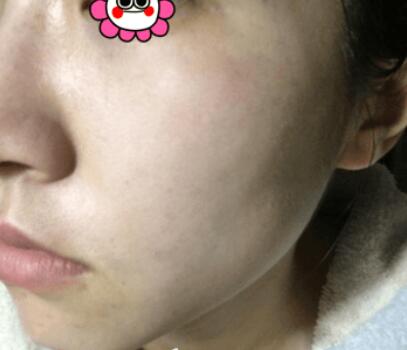 做完彩光嫩膚后的效果 做完彩光嫩膚后的效果