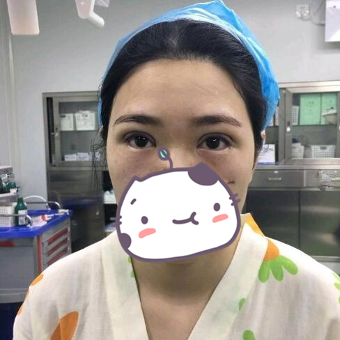 做完雙眼皮手術(shù)的幾天