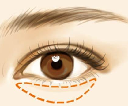 上海美萊醫(yī)療美容門診部祛眼袋