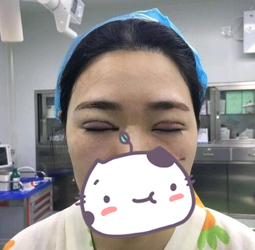 剛做完雙眼皮手術(shù)