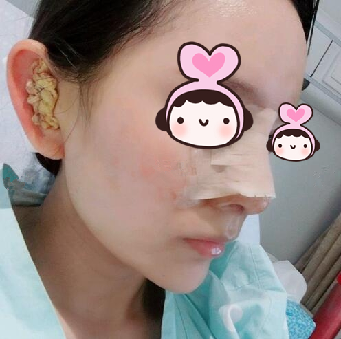 廈門海峽整形專家王翼耕做隆鼻的心得體會，王翼耕做隆鼻效果怎么樣？