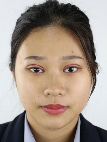 師麗麗雙眼皮案例分享