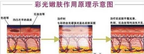 彩光嫩膚原理示意圖