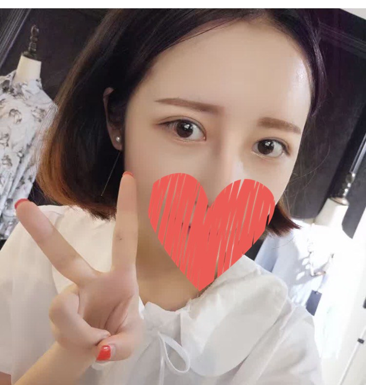 杜園園開外眼角案例效果對比圖 杜園園開外眼角案例效果對比圖