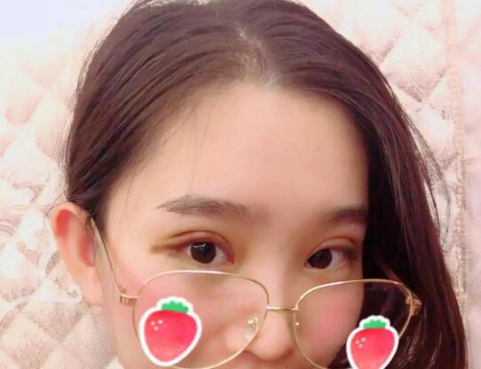 鄭州蕾娜斯彭沖醫(yī)生做微創(chuàng)雙眼皮案例效果對比圖