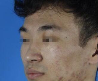 謝娟醫(yī)生做彩光嫩膚案例