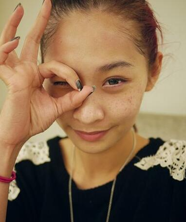 北京悅秀醫(yī)療整形專家楊勇山做激光去黃褐斑效果怎么樣？真實(shí)案例展示