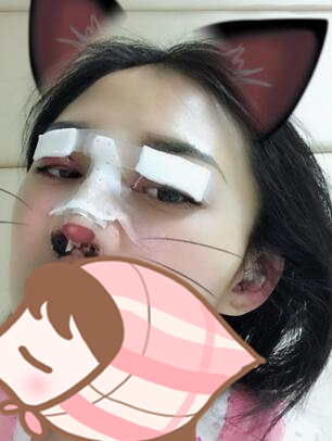 北京延世醫(yī)療整形專家周宜國做開外眼角技術(shù)怎么樣？