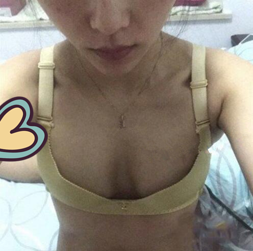 廣州駐顏光醫(yī)療美容診所整形專家劉培做復(fù)合隆胸技術(shù)怎么樣?附案例