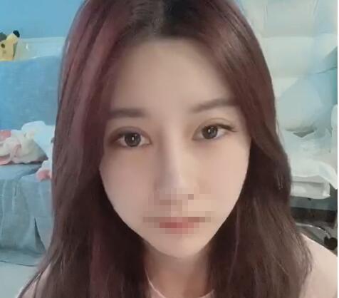 鼻綜合整形手術(shù)恢復(fù)效果