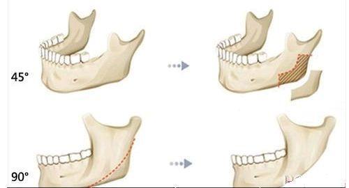 磨骨手術(shù)的介紹 磨骨手術(shù)的介紹